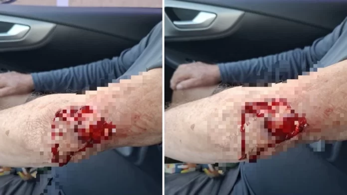 Idoso de 80 anos é atacado por pitbull solto na orla de Stella Maris ATAQUE Idoso de 80 anos e atacado por pitbull sem coleira em praia de Stella Maris 696x391 1