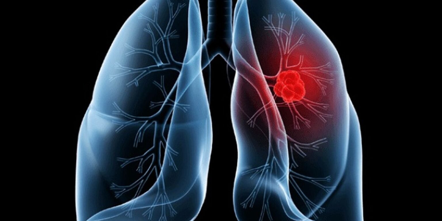 Saiba o que é adenocarcinoma pulmonar, câncer que atinge o Papa Leão XIV cancer de pulmao
